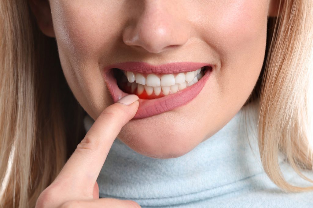 Bleeding gums, Gingivitis