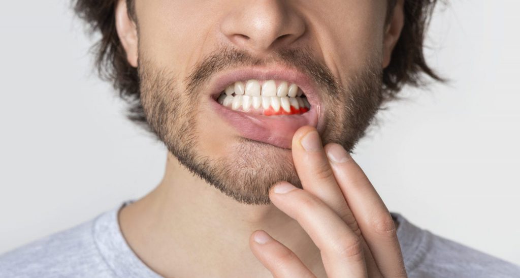 Periodontitis and Gingivitis can both be identified by swollen or bleeding gums
