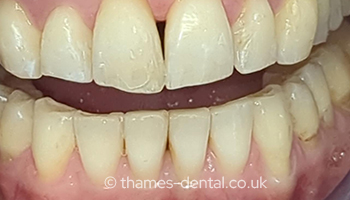 Invisalign After