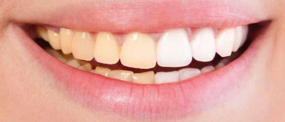 Enamel Erosion & Tooth Wear