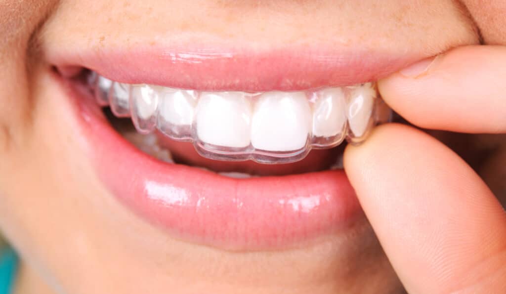 Invisalign Teeth Straightening in Kingston!