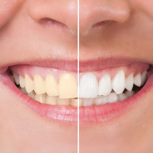 teeth-whitening-yellow-white-comparison