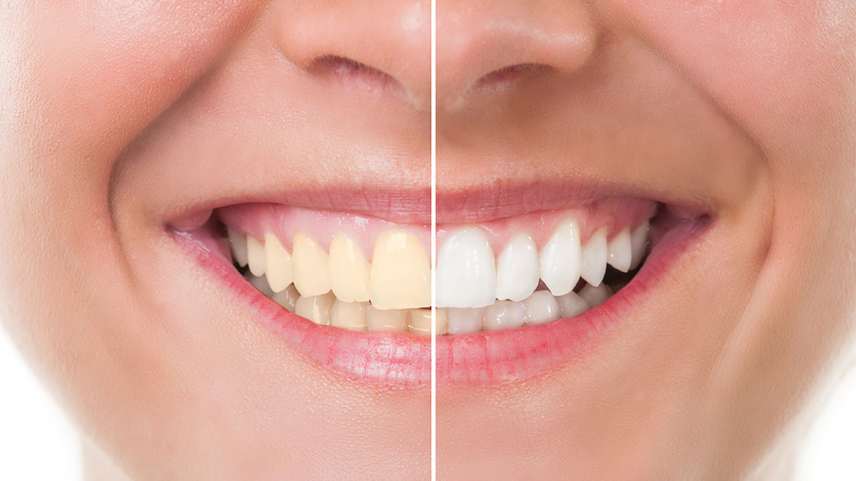 Think Twice Before Buying Teeth Whitening Kits Online!