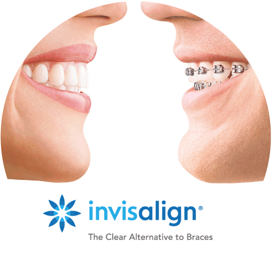 Invisalign Teeth Straightening vs Metal Braces