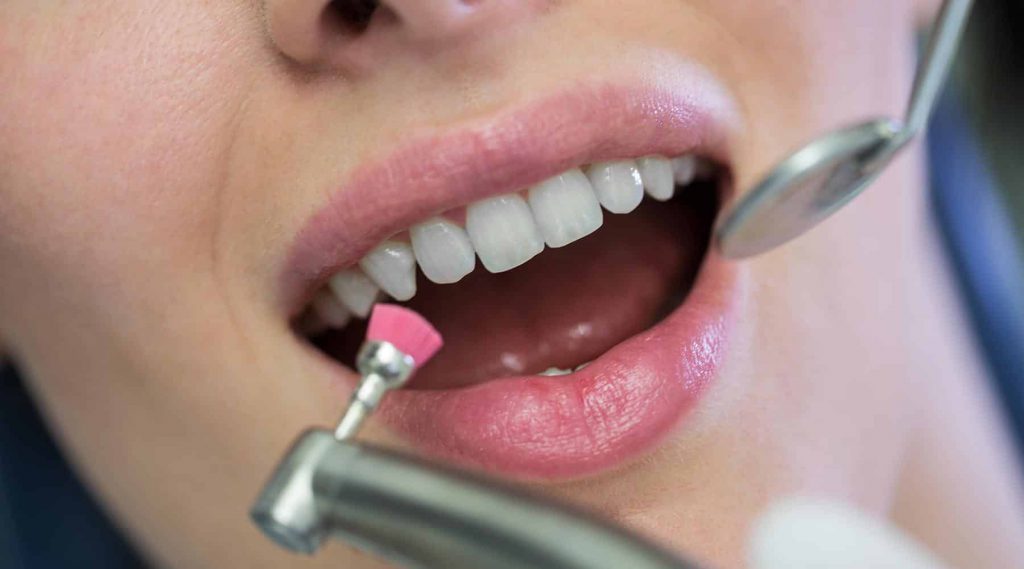 Dentist Scale and Polish Kingston