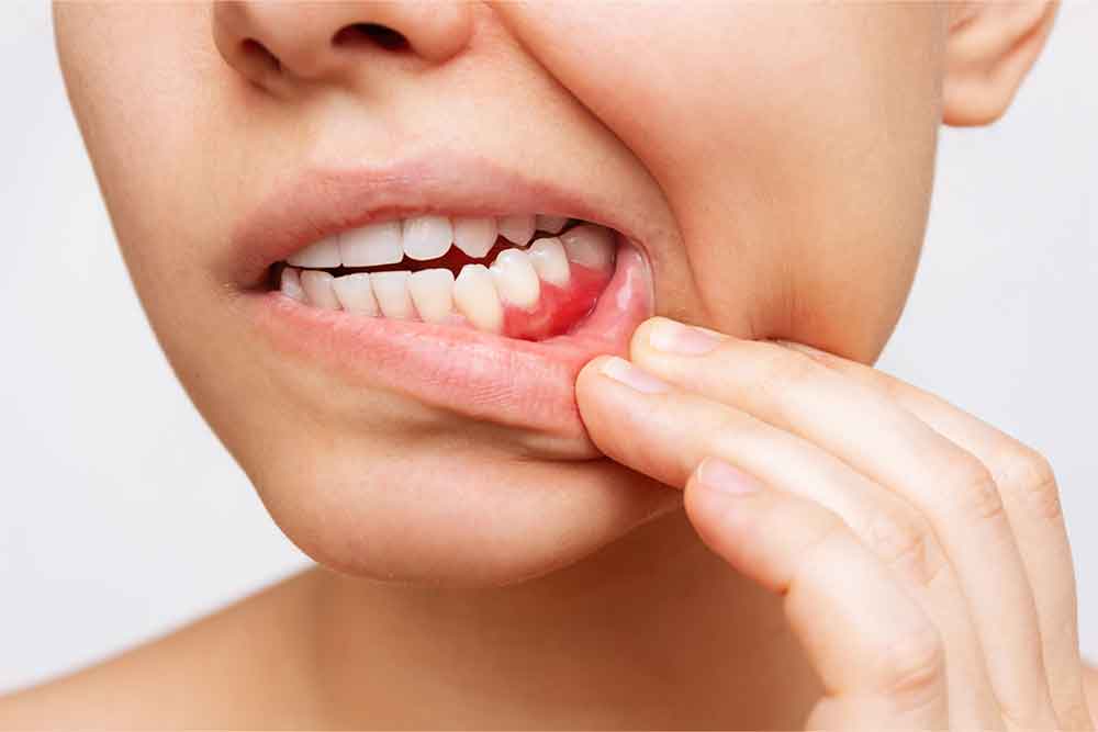 Swollen gums can be caused by dental braces