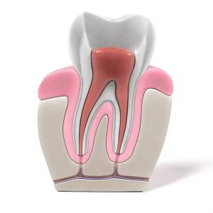 Root Canal treatment