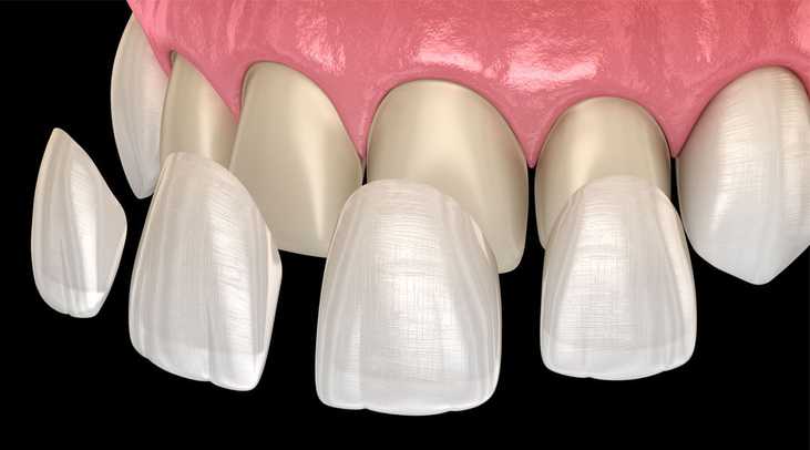 Dental Veneers